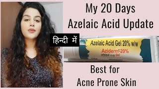 Aziderm  20 Azelaic Acid cream  hyperpigmentation acnemark azelaicacid skincareroutine [upl. by Tita761]