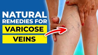 10 Natural Remedies for Varicose Veins [upl. by Perla]