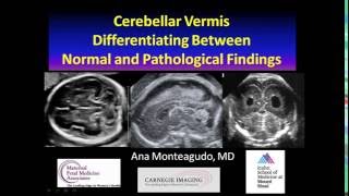 AIUM Webinar Cerebellar Vermis [upl. by Dhaf564]