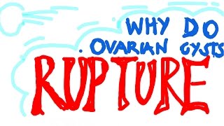 Why Do Ovarian Cysts RUPTURE What You Should Know  Cause 1 [upl. by Ffej]