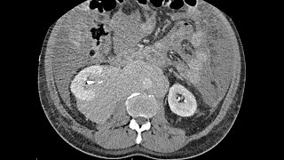 Erdheim  Chester disease  NonLangerhans Histiocytosis  highly possible diagnosis [upl. by Naitsirk]