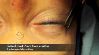 Live Surgery Upper Blepharoplasty Eyelid Lift Part 1 Markings and Anesthesia [upl. by Hterrag]