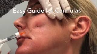 Easy Guide System for Blunt Cannulas  Dermal Fillers  Steven F Weiner MD [upl. by Joses]