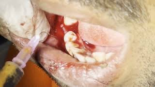 Explosive Dental abscess drainage and tooth extraction  Live On Patient [upl. by Lletnahc]