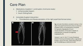 Acute Limb Ischemia [upl. by Pennie]