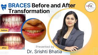 MAGICAL Braces Before and After Transformation Dr Srishti Bhatia braces smilemakeover [upl. by Paley527]