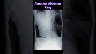 Abnormal Abdomen X ray [upl. by Yerxa]