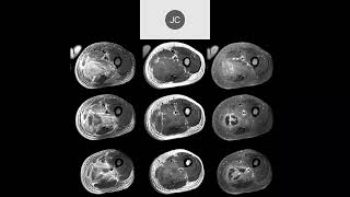 MRI of the Hip Part 8 – Hip Inflammation [upl. by Sadnalor]