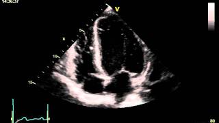 HYPERTENSIVE CARDIOMYOPATHY [upl. by Romelle54]