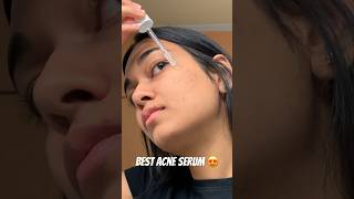 Affordable Niacinamide serum for ACNE ACNE SCARS amp MARKS shorts youtubeshorts acne [upl. by Sherborn252]