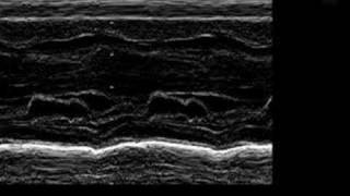 Asymmetric Septal Hypertrophy ASH in an Infant [upl. by Noreh]