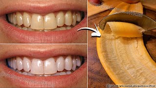 Secret that Dentists dont want you to know Remove Tartar and Teeth Whitening in just 2 minutes🪥🦷 [upl. by Acacia421]