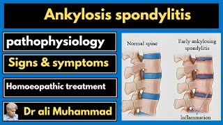 Ankylosis spondylitis and homeopathy Dr Ali Muhammad [upl. by Nora]