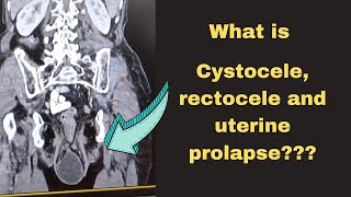 What is Cystocele and RectoceleRadiology Learning [upl. by Animsay]