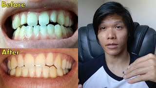 Lingual Braces Tips and My Experience INDEPTH with Timestamps [upl. by Norwood94]