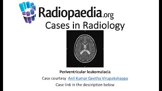 Periventricular leukomalacia Radiopaediaorg Cases in Radiology [upl. by Steffin96]