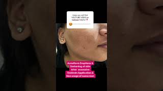 Tretinoin cream side effects  Acneiform Eruptions  Pigmentation of skin  Dr Ashima Goel MD [upl. by Desi]