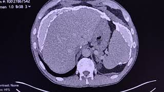 Haemodialysis related peritoneal calcifications and encapsulated peritoneal sclerosis and osteopathy [upl. by Nnayrb67]