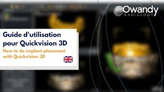 5 How to do implant placement with Quickvision 3D [upl. by Aneerahs]