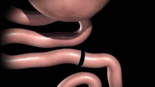 RouxenY Gastric Bypass [upl. by Pish]