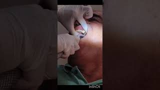 fracture tooth extraction  painless subgingival root stump extraction [upl. by Iatnwahs]