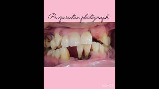 Preoperative and postoperative photographswith zirconia Bridge [upl. by Ahsinod117]