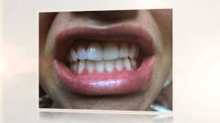 Zoom Teeth Whitening [upl. by Mayyahk]