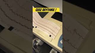 Quiz ECG  retrouvez cette arythmie [upl. by Piscatelli]