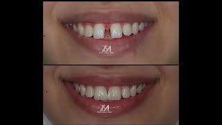 diastema closure using bioclear method [upl. by Livvy523]