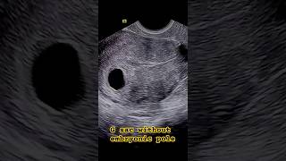 Gestational sac without yolk sac or embryonic node [upl. by Hogue]