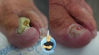 TRIMMING A quotTHICCquot TOENAIL  AMAZING BEFORE AND AFTER [upl. by Eirtemed885]