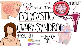 Polycystic Ovary Syndrome Made Easy PCOS Explained [upl. by Hess850]