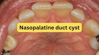 What is nasopalatine duct cyst EASY [upl. by Dnalyk655]