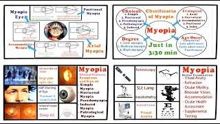 Myopia  Full Tutorial Introduction Classification Clinical Features and Management [upl. by Jeana]