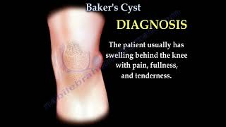 Bakers Cyst of the kneemeniscus tear arthritis of the knee [upl. by Aneehsar]