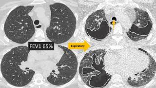 Understanding Bronchiolitis [upl. by Lilak]