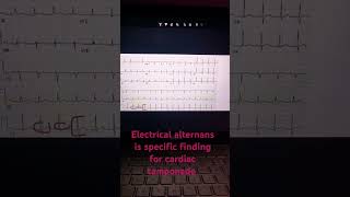 Electrical alternans in ecg [upl. by Peirsen]