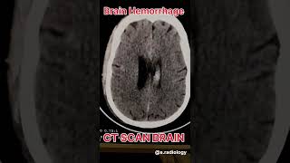 Brain Hemorrhage ct scan radiological [upl. by Nerrej]