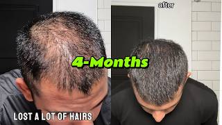 How to Reverse Your Hair Loss [upl. by Dryden690]