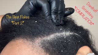 Dandruff Scratching Compilation Lots of Dandruff Flakes Popping Part 2 [upl. by Acysej]