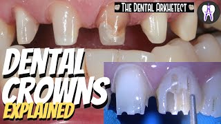 DENTAL CROWNS Patients Request to Make Her Teeth Uniform 4k c34 dentist [upl. by Eldwon]