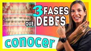 Brackets proceso 𝗠𝗘𝗦 𝗮 𝗠𝗘𝗦 📆 Las ③ 𝐄𝐓𝐀𝐏𝐀𝐒 del TRATAMIENTO de Ortodoncia  Te lo explico ✅ＦÁＣＩＬ [upl. by Uzial]