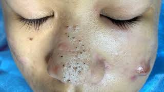 Big Cystic Acne Blackheads Extraction Blackheads amp Milia Whiteheads Removal Pimple Popping 0298 [upl. by Anavahs]