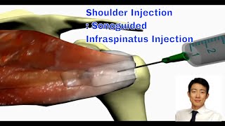 Shoulder Injection Therapy The Ultrasoundguided Approach for Infraspinatus [upl. by Lled]