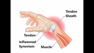 Tenosynovial Crepitus  Definition Meaning Causes Symptoms Treatment [upl. by Ahsiela]