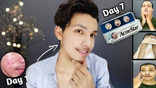 Acne Star Gel  How To Use  Result  Really Works  Honest Review  Acne Pimple Spots  Hindi [upl. by Llehcram]