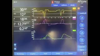 A Case of Patientventilator Asynchrony [upl. by Ellevel431]