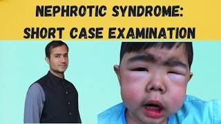 NEPHROTIC SYNDROME Practical approach to short case examination [upl. by Eimmaj170]