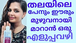 തലയിലെ പേനും ഈരും മുഴുവനായി മാറാൻ ഒരു എളുപ്പ വഴി How to remove Lice easily Permethrin Cream Review [upl. by Milah]