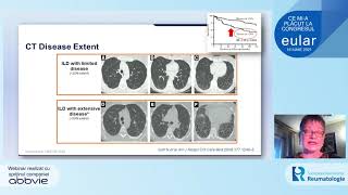 Eular  16 iunie 2021  Scleroza sistemica  Magda Parvu [upl. by Martha]